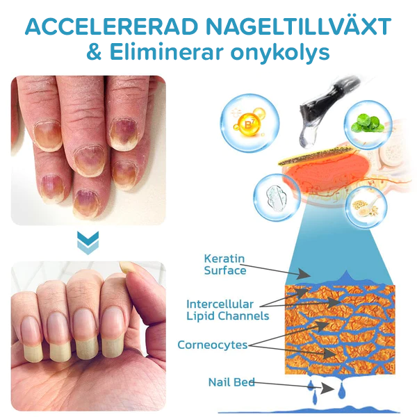 Onycholysis Heal: Nagelstärkande och Tillväxt Reparera Essens 💅✨