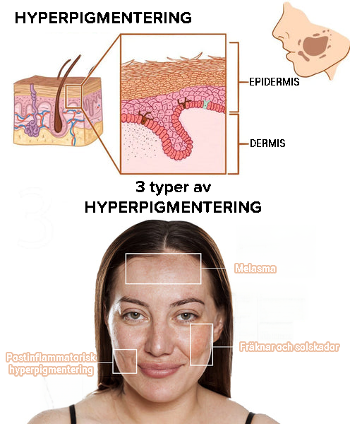 Snabb borttagning av mörka fläckar Melaninkorrigerande ansiktsserum