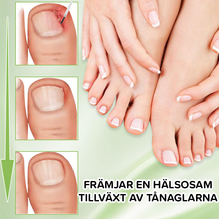 FungiFix Nagelsvamp Närande Behandlingsvätska